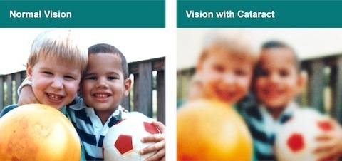 Photo of two children as seen with normal vision compared to blurred image as seen with cataract