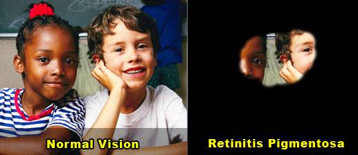 Image of two children seen with normal vision compared to tunnel vision caused by RP