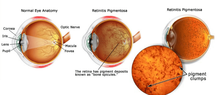 Retinitis pigmentosa eye diagram comparing a normal eye to a retina with pigment deposits