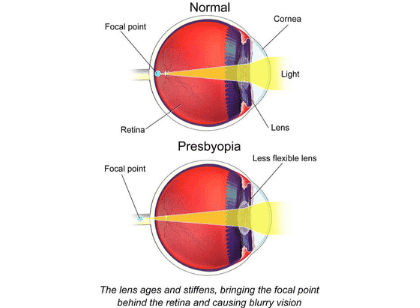 Aging (presbyopia) eye diagram comparing a normal eye to an aging eye