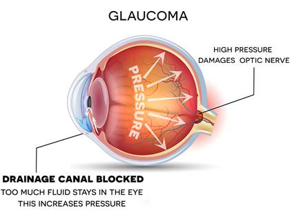 Glaucoma eye diagram