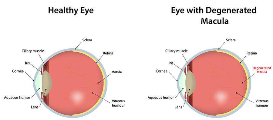 Macular degeneration eye diagram comparing a healthy eye to an eye with a degenerated macula